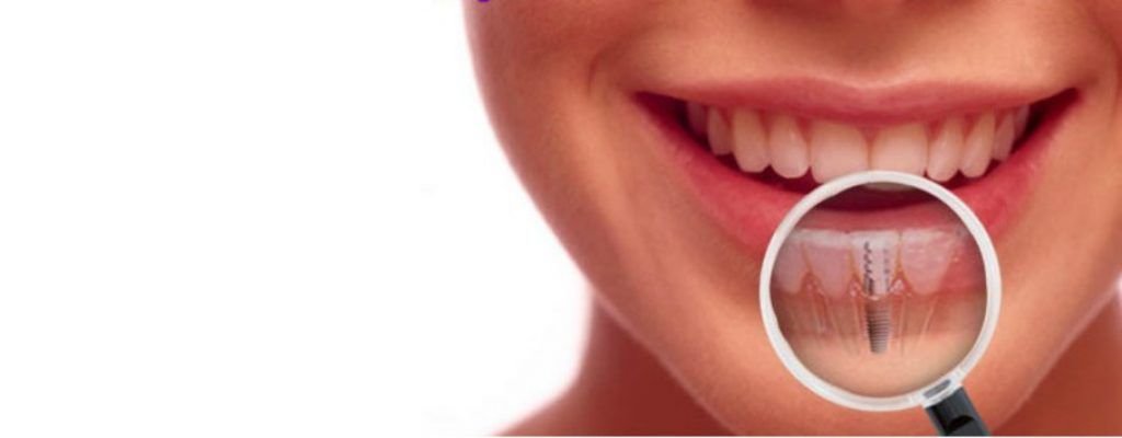 All About Dental Implants