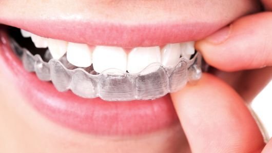 clear aligners in gurgaon